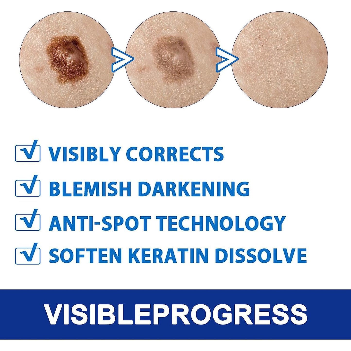 Ungüento para eliminar verrugas 20 g