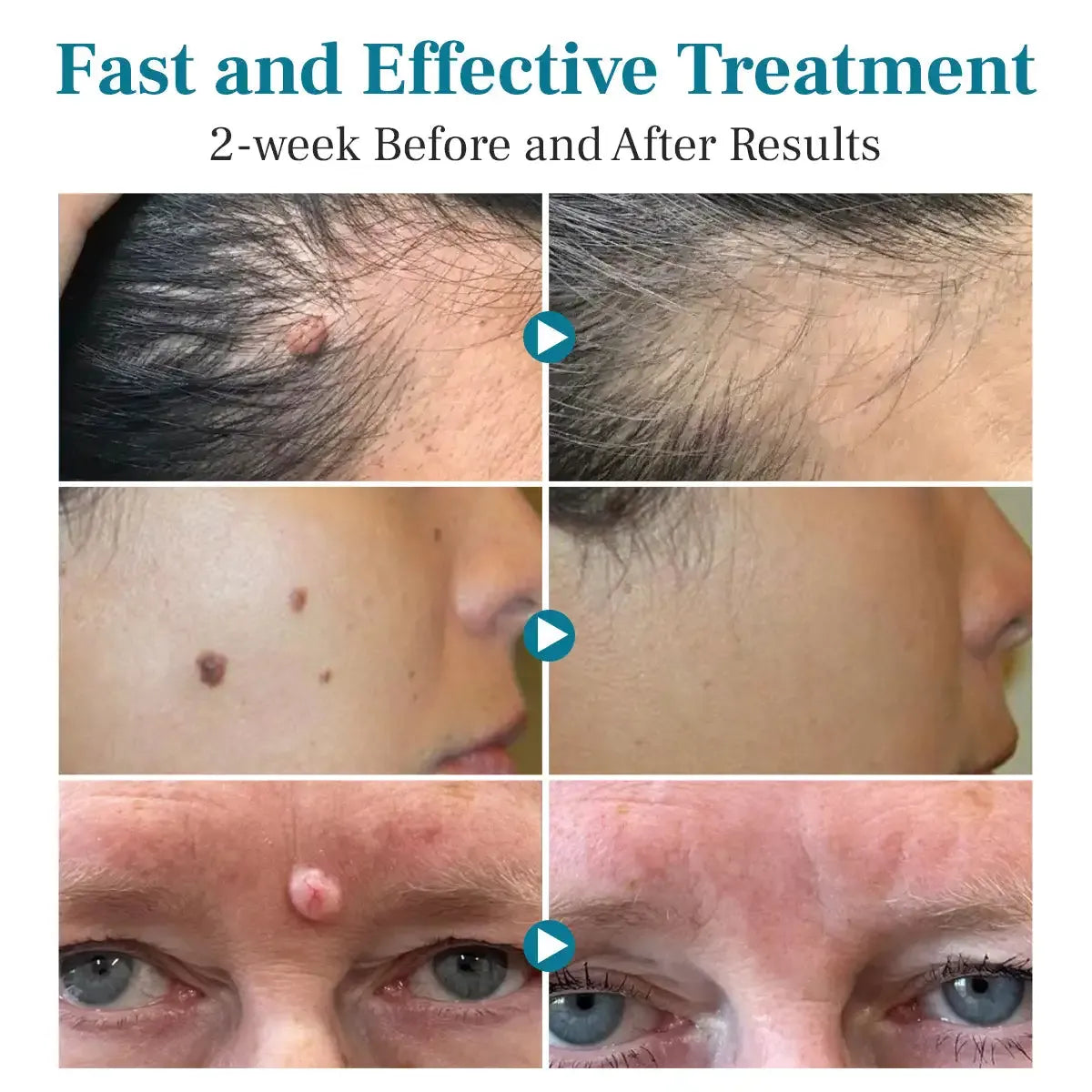 LÁPIZ LÁSER PARA ELIMINAR VERRUGAS Y LUNARES