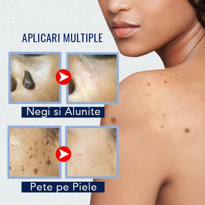 CREMA CONTRA VERRUGAS Y MANCHAS PIGMENTADAS